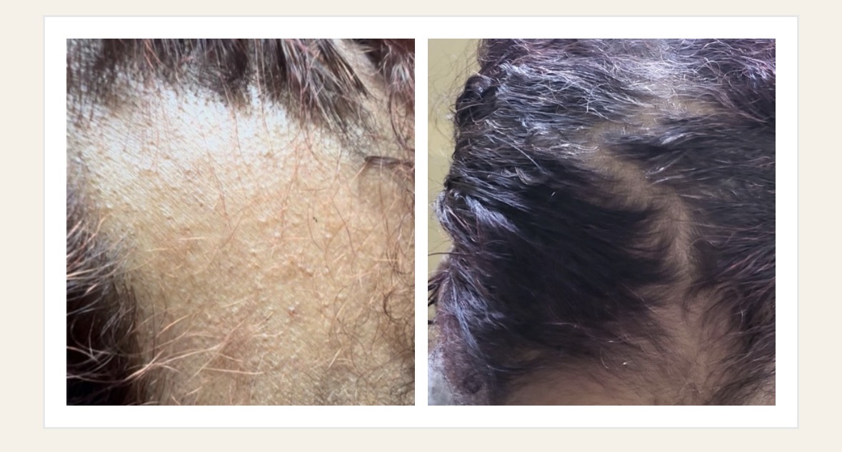 First photograph of the side of the scalp.