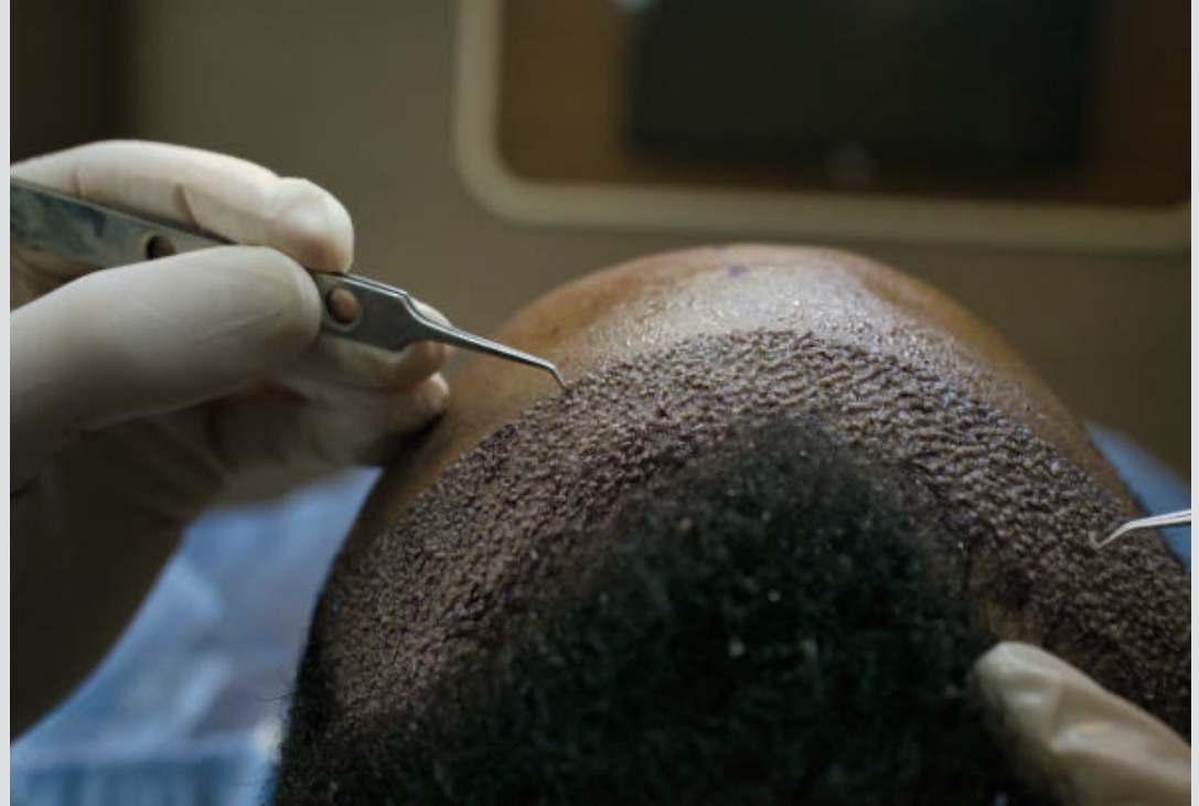 Hair transplant procedure on Afro-textured hair