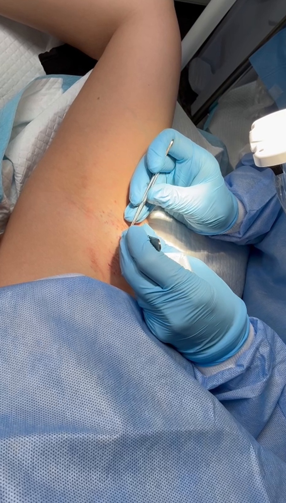 Body hair follicle extraction from the underarm area