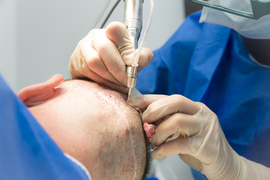 Hair transplant procedure using surgical extraction equipment