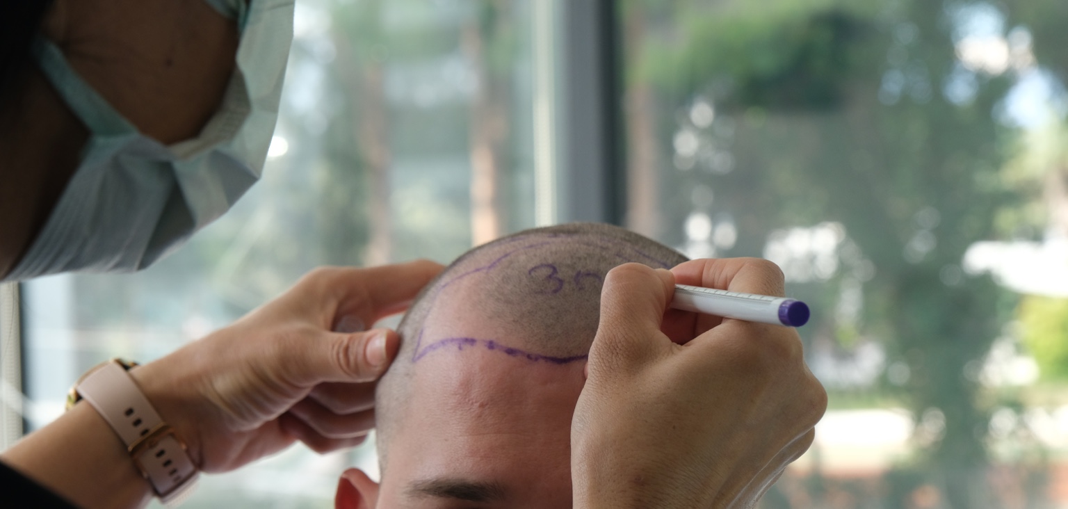 Hairline planning before a FUT hair transplant